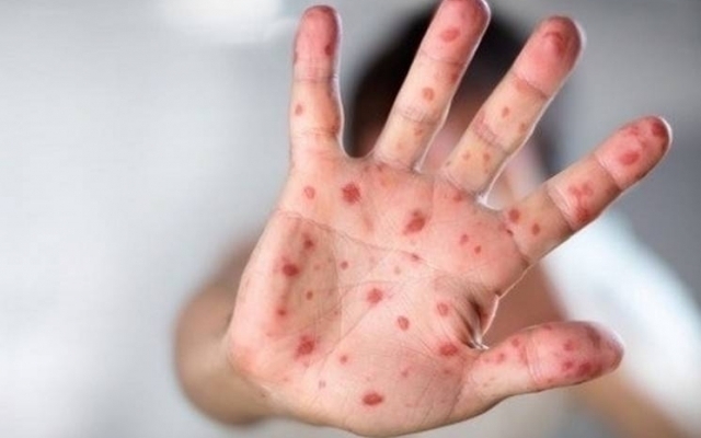 В Днепре врачи фиксируют новые случаи заболевания корью Фото № 0 В Днепре врачи фиксируют новые случаи заболевания корью Фото № 0