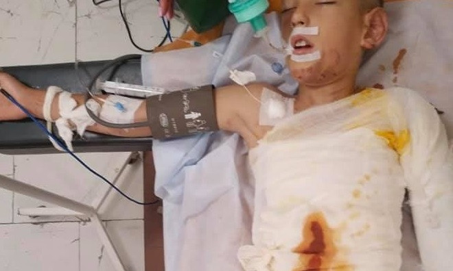 ЧП в Днепре: 8-летнего мальчика облили бензином и подожгли 