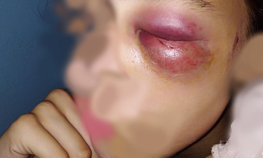 ЧП на Днепропетровщине: девочку избивали на глазах у взрослых