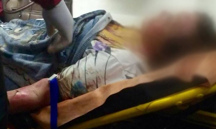 ЧП под Днепром: женщина пыталась развести костер и попала в больницу 